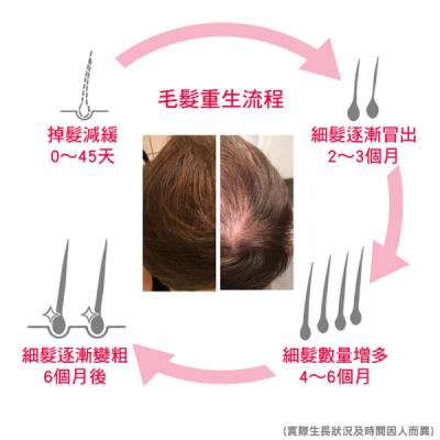 iRestore雷射生髮帽-衛生教育文章-生髮流程