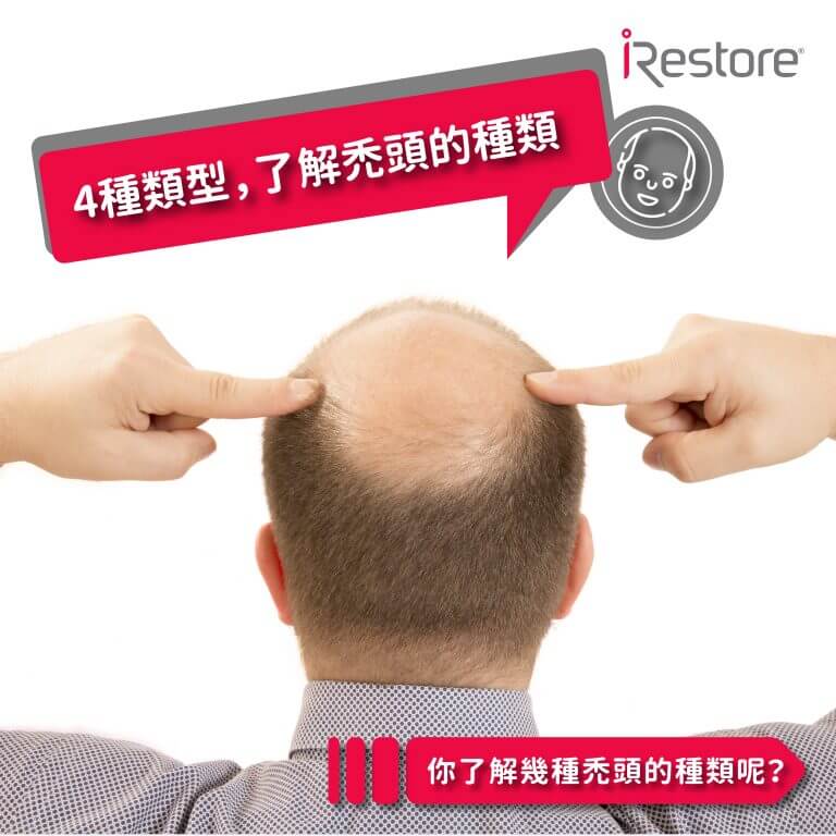 iRestore雷射生髮帽-衛生教育文章